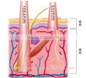 Best nd yag laser tattoo removal with good quality
