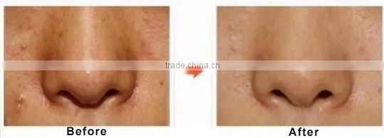 CE Certificated hydro facial dermabrasion spa equipment scrubber machine Hydrodermabrasion in alibaba