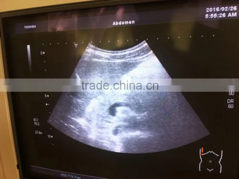 Refurbished Toshiba ultrasound scan probe PVT-375BT doppler color transducer for Xario Aplio