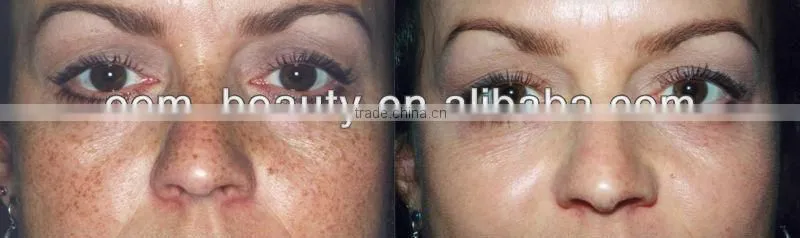 Hight quality IPL beauty machine A003 at Low price