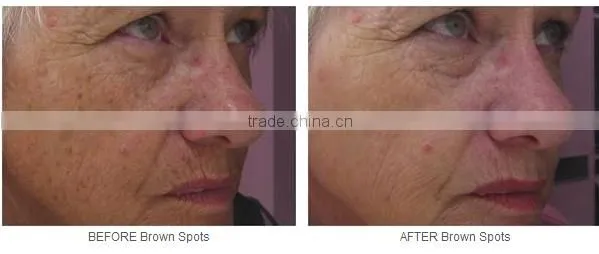 PTP Q Switch laser hair removal long pulse nd yag pigment tattoo removal machine yag picosecond laser