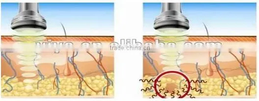 CE approval VY-M2 body shaping skin tightening machine
