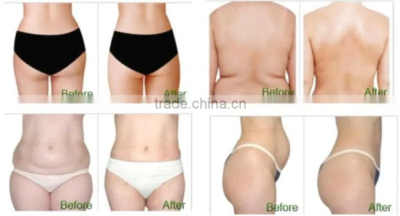 body shaping cryolipolysis fat freezing for body slimming machine