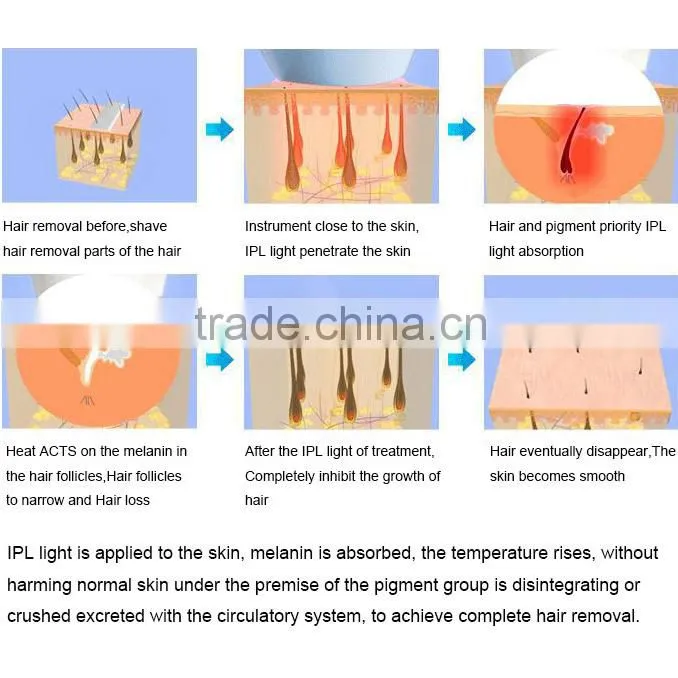 Best Choice Laser Cosmetic Equipment Portable Hair Removal Instrument in USA