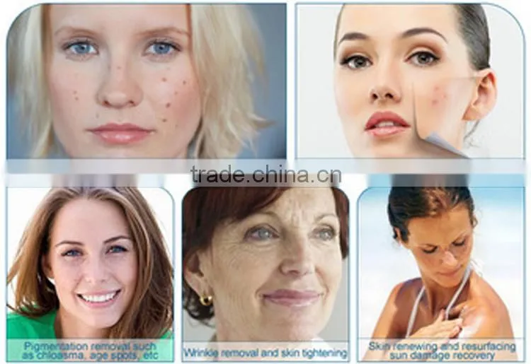 Fractional CO2 Laser Skin Resurfacing Scar Removal Stretch Mark Removal