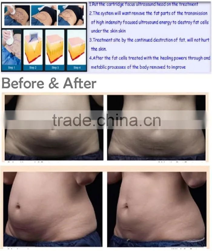 2016 Effective Weight Loss Body Shaping 8mm 13mm HIFU Body Slimming Machine