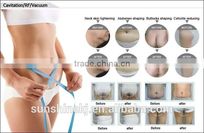 The most cost-effective biggest demand CE approved laser hair removal machines ipl