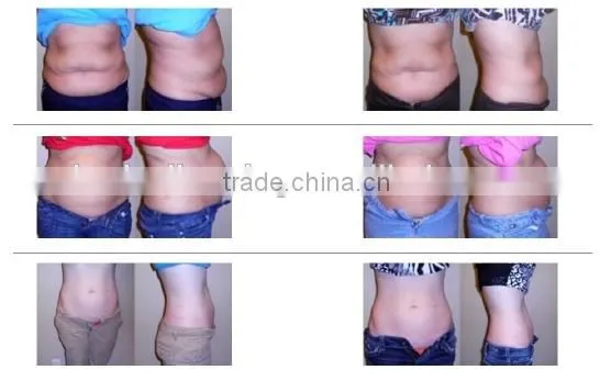 Global Trade roller cellulite machine syneron velasmooth