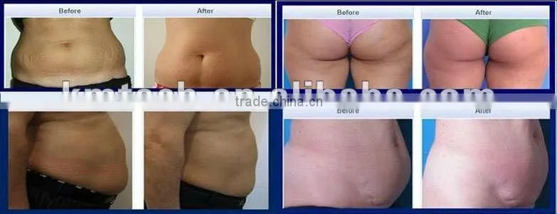 Newest 4 in1 ultra slim liposuction system