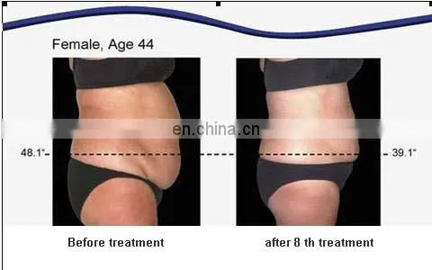 2019 Fashion best lipolaser 650 slimming machine 650nm lipo laser