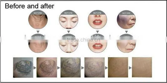 portable yag laser beauty parlor equipment