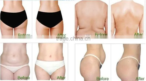 Portable Lipo Laser for fat removal equipment home use