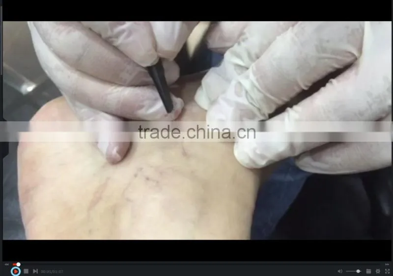 30MHz RBS maquina para quitar varices & machine to remove varicose veins