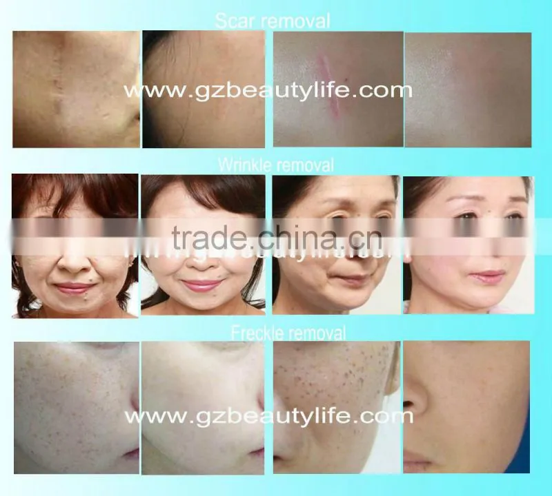 2016 Laser RF Fractional CO2 Laser Vagina Tightening/CO2 Laser Scar Removal Machine/RF