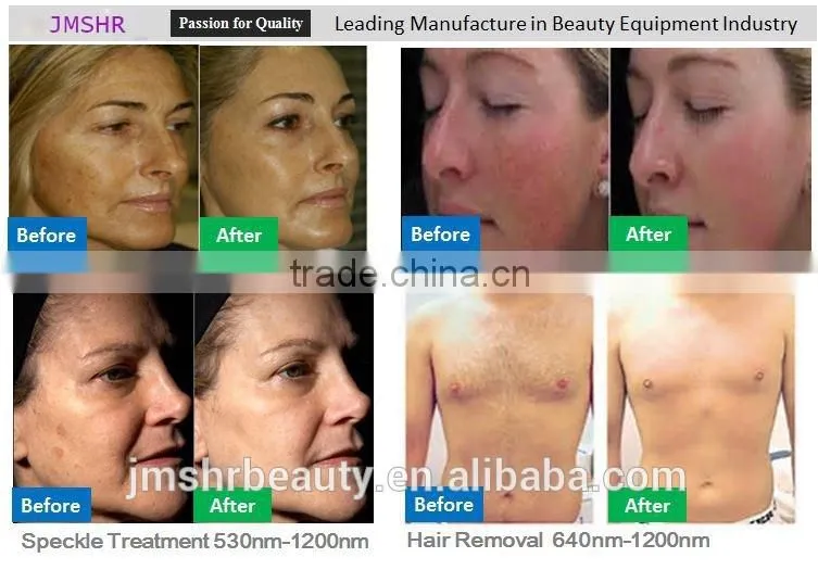 Portable hair removal laser machines for sale with factory price