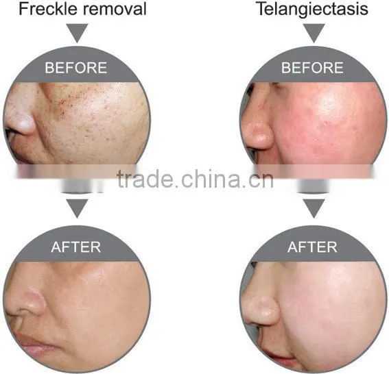 Elight rf+ipl solon use face lift machine for vascular/wrinkle/acne removal