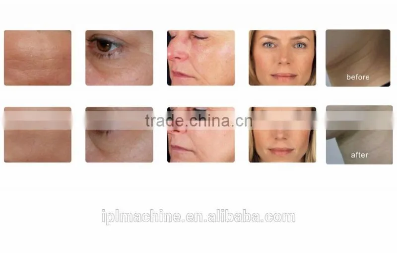portable pdt beauty equipment