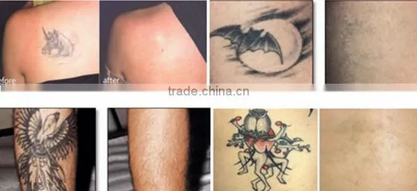 The most Professional in all skins home use laser tattoo removal machine