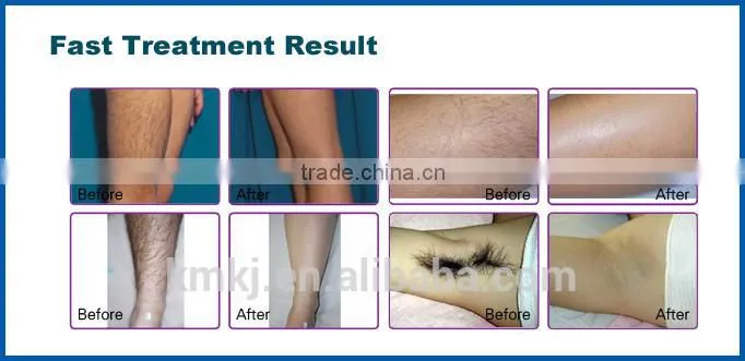 Two treatment handles !! opt shr hair removal machine with hot sale (CE,ISO,SGS,TUV)