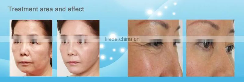 Hottest!!! Anti-wrinkle High Intensity Focused Ultrasound Knife