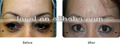 100% High Quality Skin Resurfacing Acne Scar Removal Fractional Co2 Laser Equipment