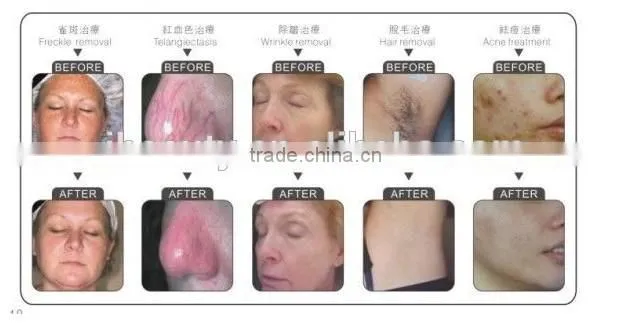 Lowest price professional ipl hair removal skin rejuvenation IPL machine