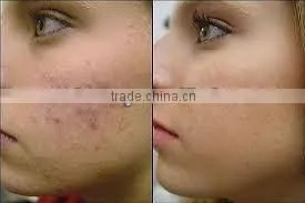 Portable and professional new design ipl shr hair removal macine