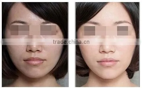 Protable soprano laser hair removal machine P003