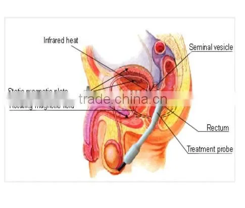 good effective prostate therapy device