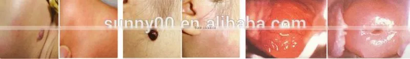 Professional High Quality Medical co2 Laser for General Surgical Equipment