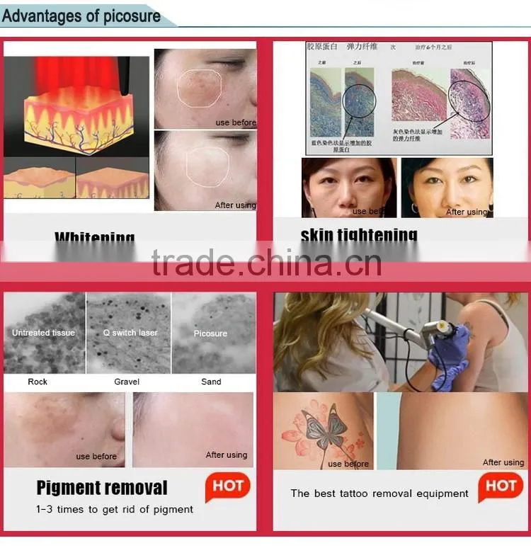 Q-Switch Nd Yag Laser Tattoo Removal System/Q Switched Laser For Tattoo Removal