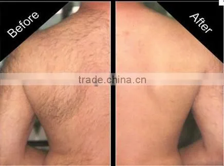 Best Spa Equipment Facial Hair Remover Permanently Nd Yag Laser Hair Reduction -P003