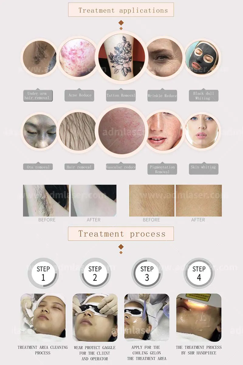 CE Approved IPL Laser Elight Ipl for Hair Removal and Whiten Skin E-light OPT Hair Removal Beauty Machine