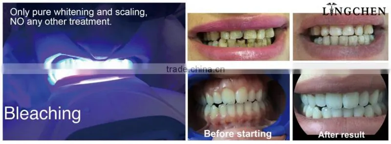 Guangzhou Lingchen dental Whitening system portable teeth whitening machine