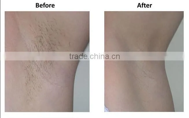 VY-9014D Keyword 2014 best shr ipl laser hair removal machine price