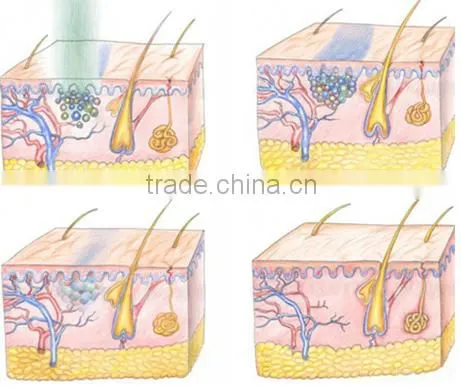 ce approved factory direct supply best prices q switch nd yag laser machine remove tattoo