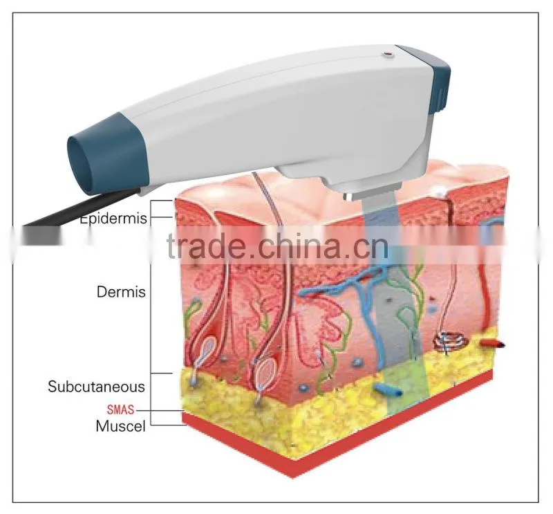 High Intensity RF Machine for Skin Tightening Face Lifting