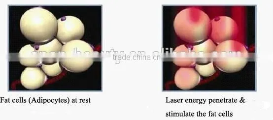 handheld laser hair removal