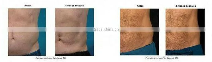 2014 most popular! ultrasound cavitation /cavitation rf/ body slimming machine