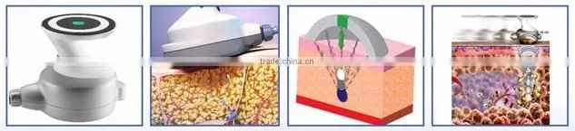 Fast result Ultrashape technology clinically proven FDA cleared hifu ultrasound machine FOR body slimming