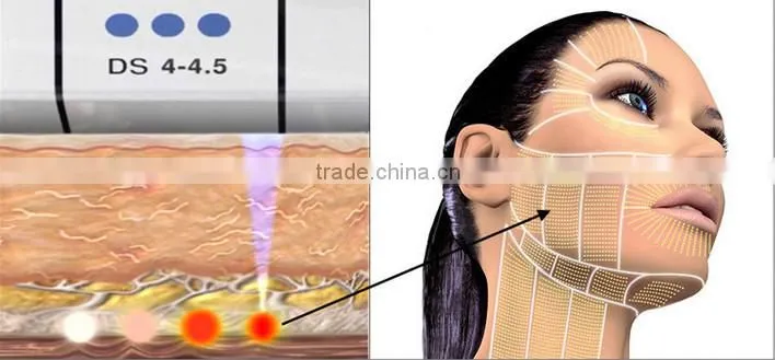 portable no-surgical treatment to tighten sagging skin beauty machine