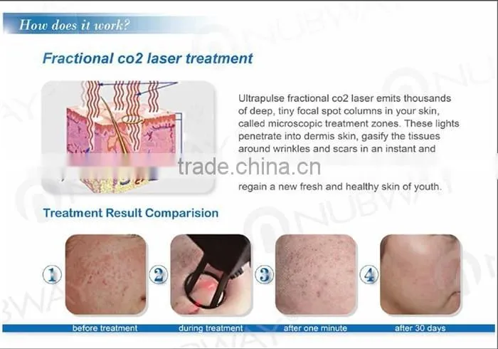 40W Fractional CO2 Laser Acne Scar & Wrinkle Removal / Co2 Laser Surgical Product Vaginal Applicator