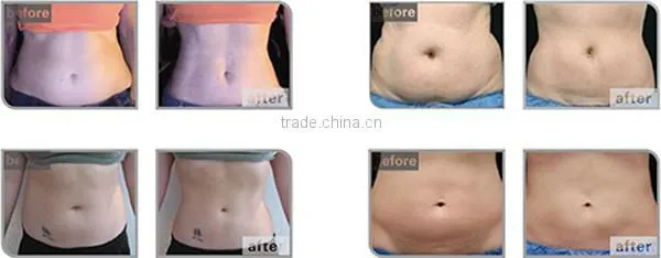same work cryolipolysis fat reduction device body cool shape