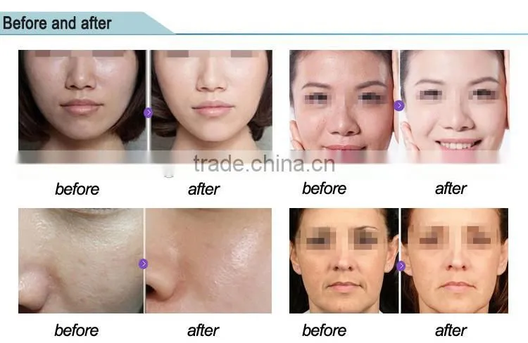 MINI OXY SKIN HO2 Oxygen Spray machine (Factory/CE)