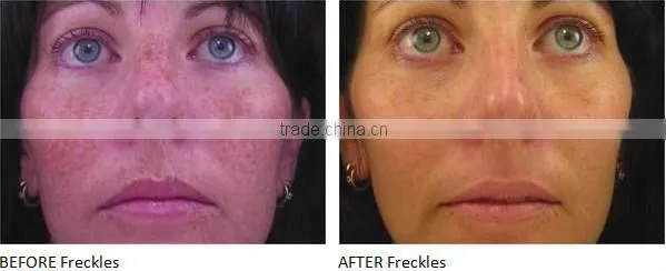 Best IPL Skin Rejuvenation/Anti Ageing ipl laser machine