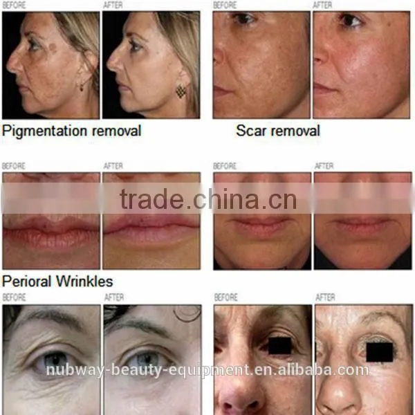 Top quality & best selling!!! linexel fractional co2 fractional laser co2 fractional laser with CE