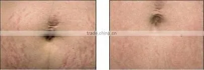 cosmetic implement freckle removal ce certificate derma roller 1080 needles changeable head body roller-L008