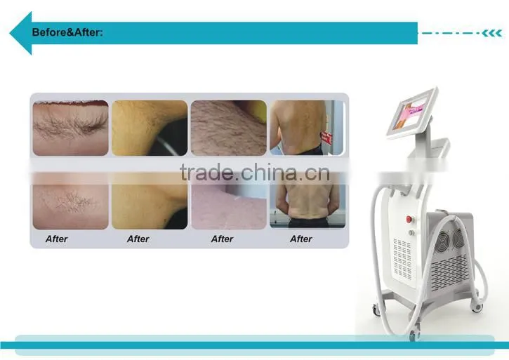 Diode Laser Bar 808nm Depilation System