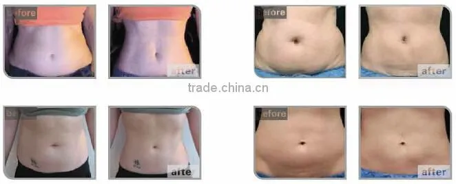HIFUSHAPE nubway hifu for body slimming fat loss hifu equipment