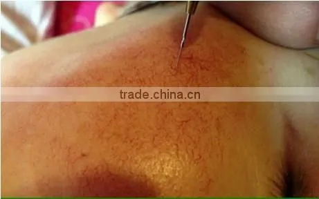 factory price best beauty device / facial veins removal / varicose vein treatment equipment